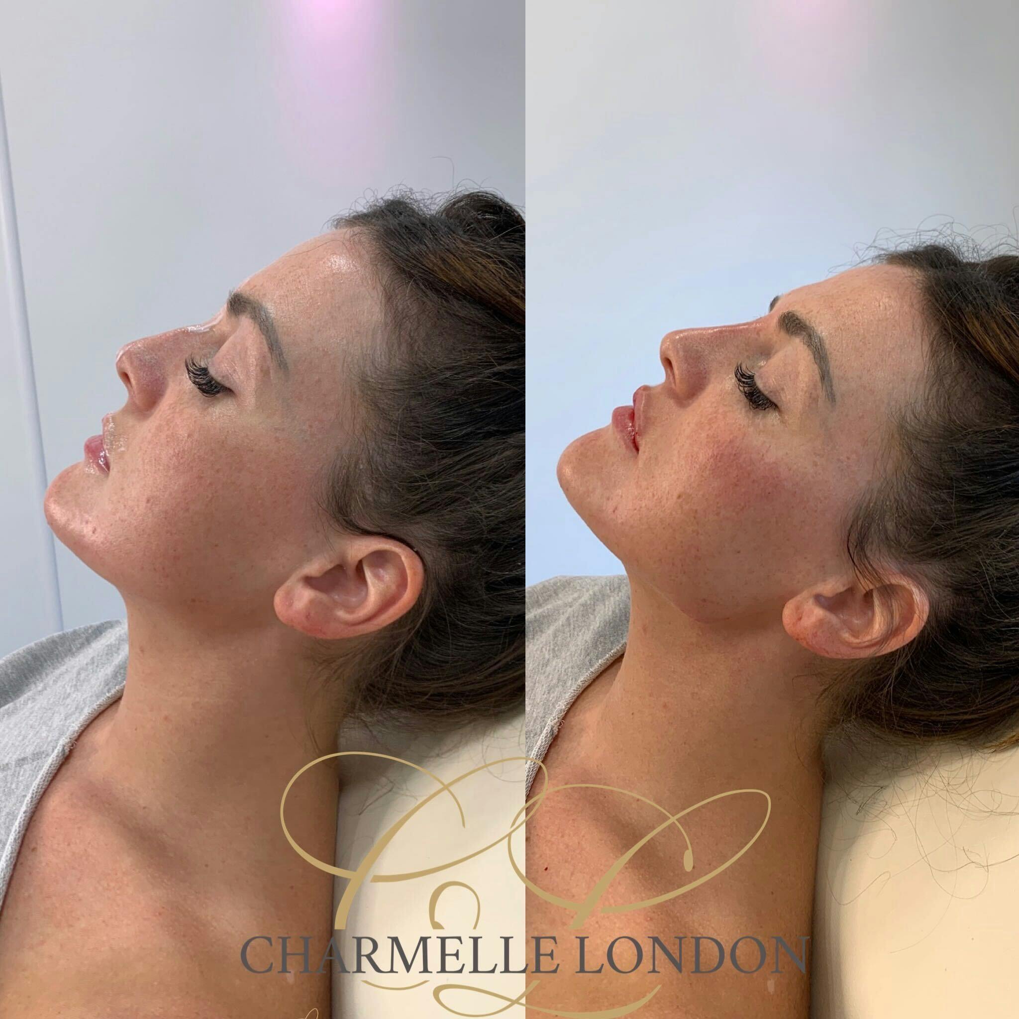 Dermal Fillers: A Review on What You Need to Know